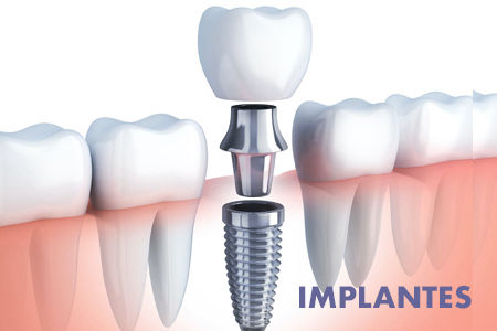 Dra. Grisoski - Implantes